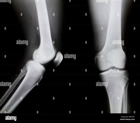 Normal knee x ray hi-res stock photography and images - Alamy