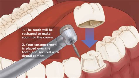 Dental Crowns Altamonte Springs, FL - Orlando, FL - Tooth Crown - Schmitt Prosthodontics