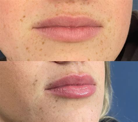 Lip Flip Before and After: Photos and Everything You Need to Know