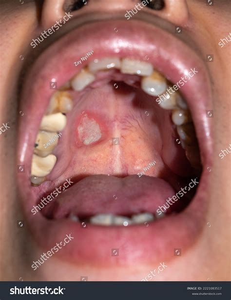 Canker Sore Soft Palate Could That Sore In Your Mouth Be Cancer?