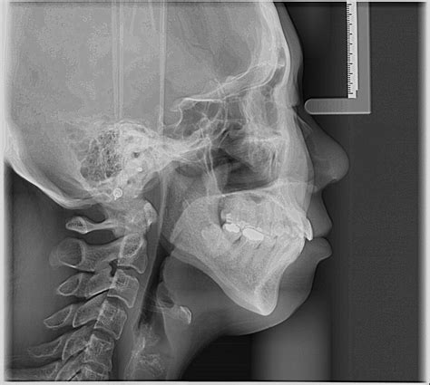 Cho Orthodontics - Procedure: Radigraph