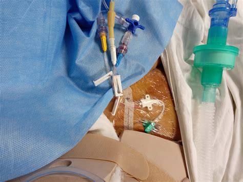 Central Venous Catheter Arterial Line at Michael Thornton blog