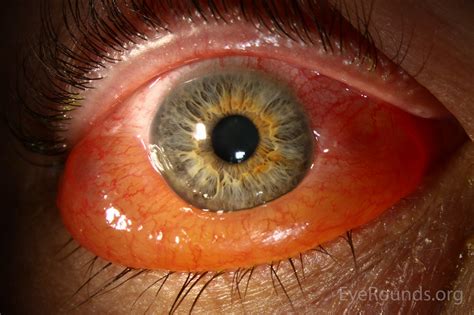 Conjunctival Edema