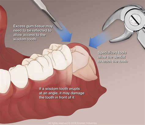 Wisdom Teeth Removal Warsaw, IN - Dental Solutions