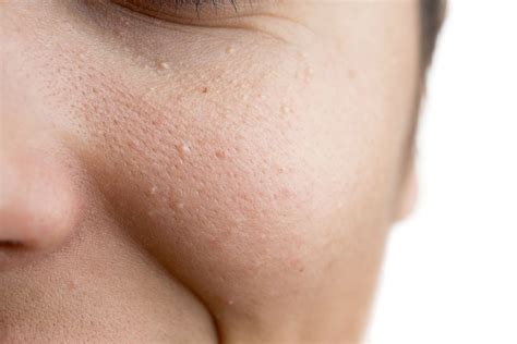 White Bumps Under Skin On Face
