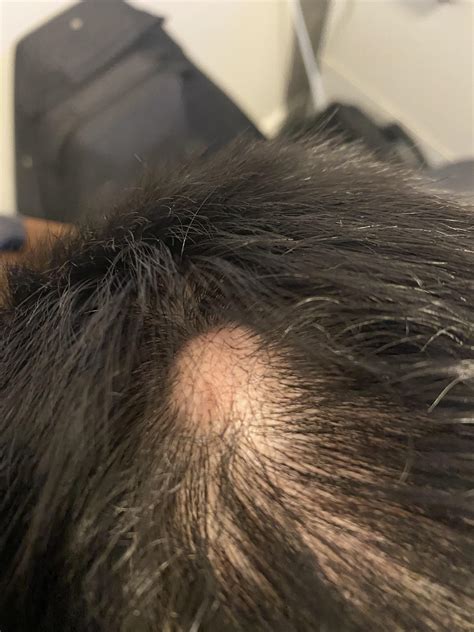 Hard lump on top of head, recently discovered bald spot. What could it be? See comments for ...
