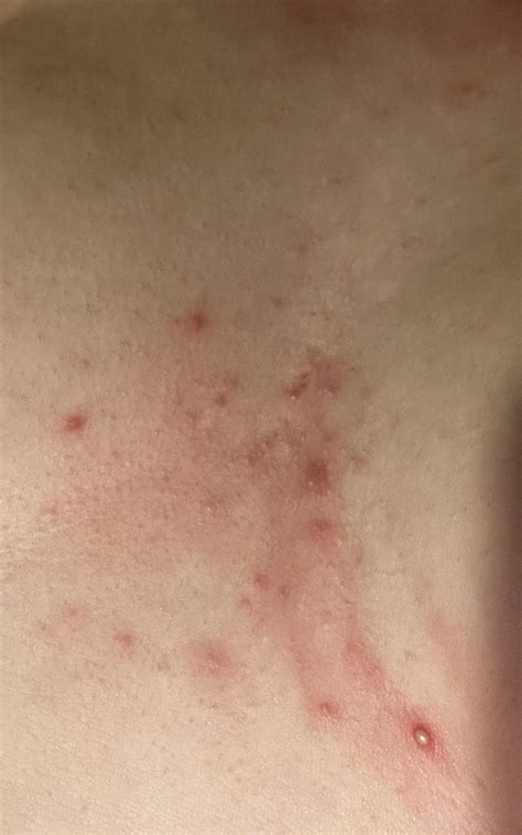 Been getting acne between my breasts for a few months now. No dietary ...
