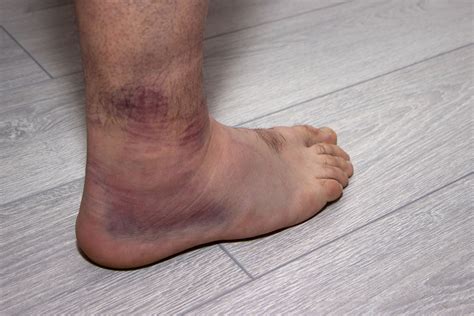 Ankle and Foot Fractures Baton Rouge | Ankle Fracture Doctor Baton Rouge