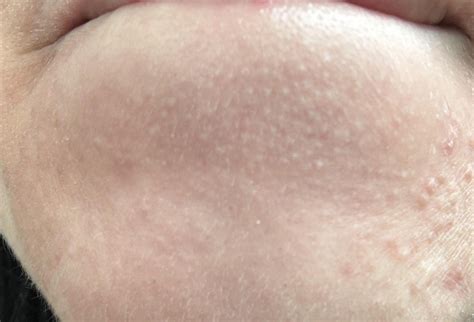 What are these bumps on my chin and how do I get rid of them? : r ...