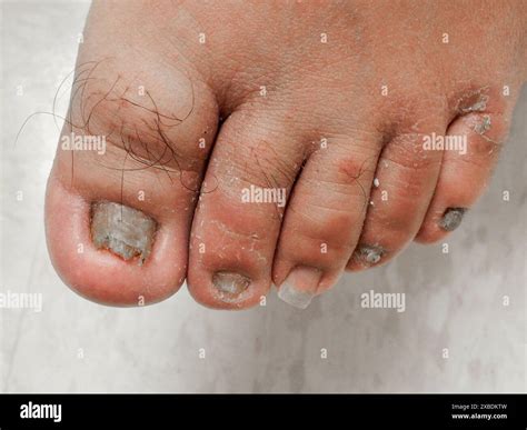 Is Athletes Foot Contagious