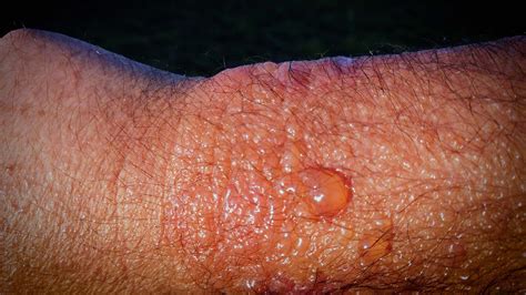 How Dish Soap Can Prevent Poison Ivy Rash Fast