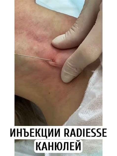 Убираем дряблость кожи на шее. Препарат Радиесс (Radiesse) канюльная ...
