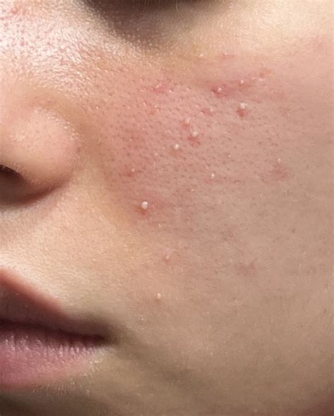 Gram Negative Folliculitis? – Acne – Acne.org Forum