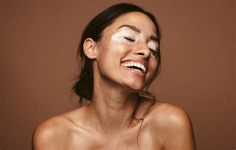 Vitiligo: Causes, Treatments, and More | POPSUGAR Beauty UK
