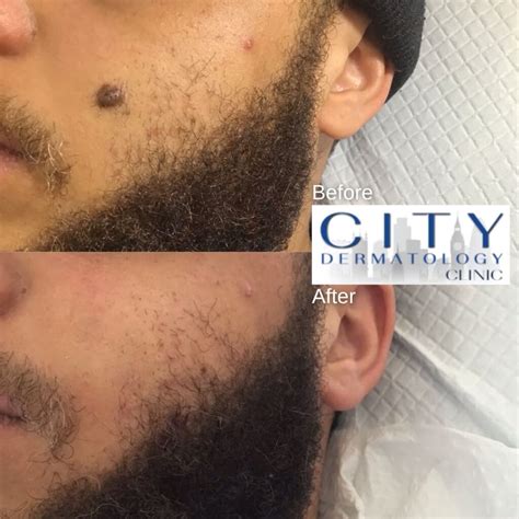Mole On Face Removed Mole Removal London Top Plastic Surgeon