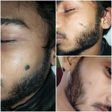 Scar Mole Removal Services in Ghaziabad, Delhi NCR