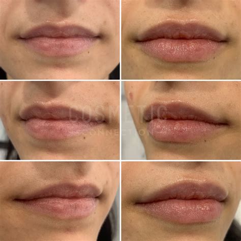 Choosing the Right Lip Filler Size | Cosmetic Connection
