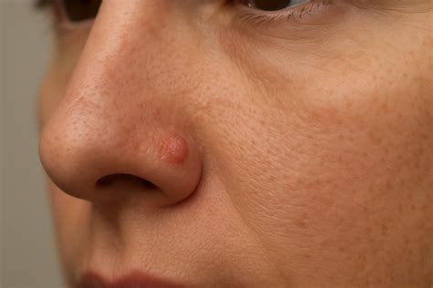 Affordable Fibrous Papule Removal Treatment - Perfect Image Consultants London