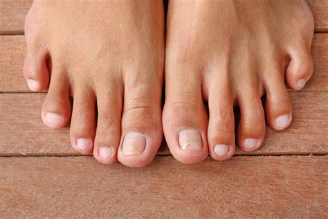 Thick Toenails: Causes, Home Remedies & Podiatric Care | The Foot Practice
