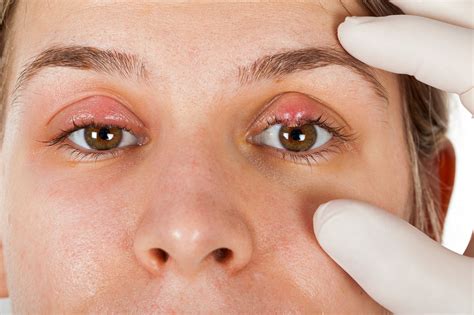 Eye Stye: Causes, Symptoms & Treatments | Eye Concepts