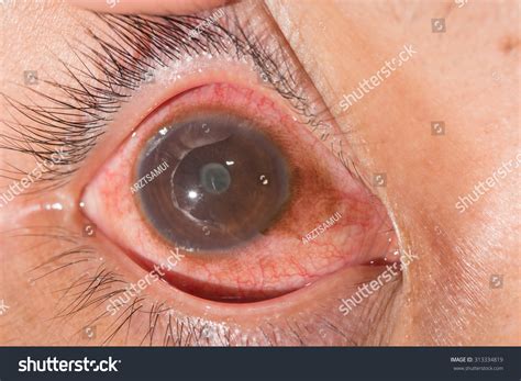Anterior Vs Posterior Synechiae