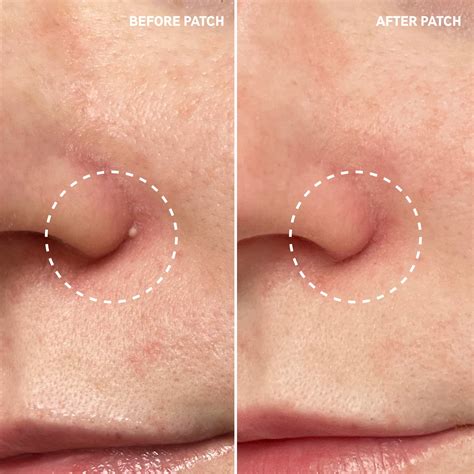 Hydrocolloid Acne Pimple Patch | The INKEY List USA