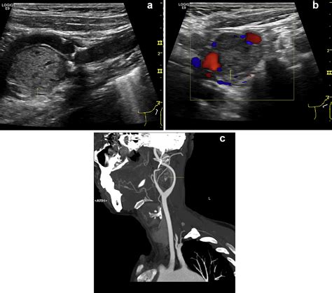 Color Doppler Ultrasound in Diagnosis and Assessment of Carotid Body ...