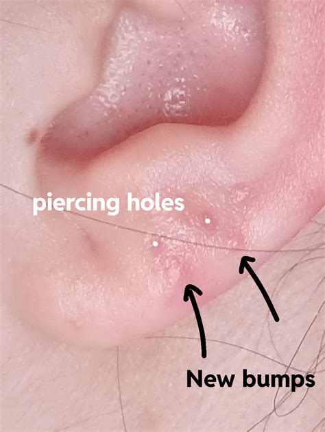 Pimple like bumps have appeared next to my old lobe piercing sites ...