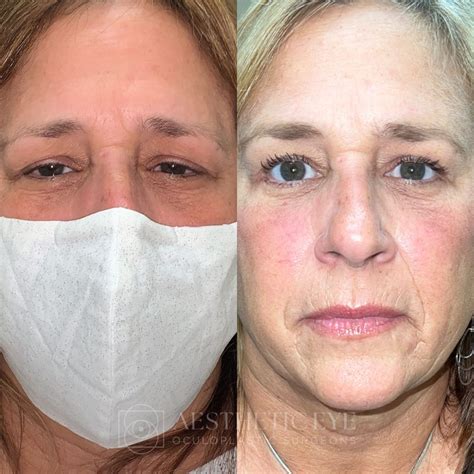 Cincinnati OH Forehead/Brow Lift Surgery | Dayton Endoscopic Browlift