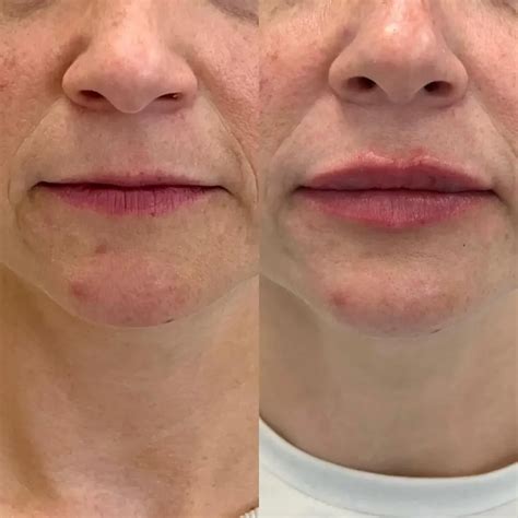 Lip Flip Before and After - Before After Journey