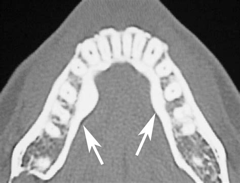Radiologic and Pathologic Characteristics of Benign and Malignant Lesions of the Mandible ...