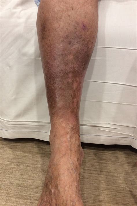 What Causes Brown Spots On Your Lower Legs - Infoupdate.org