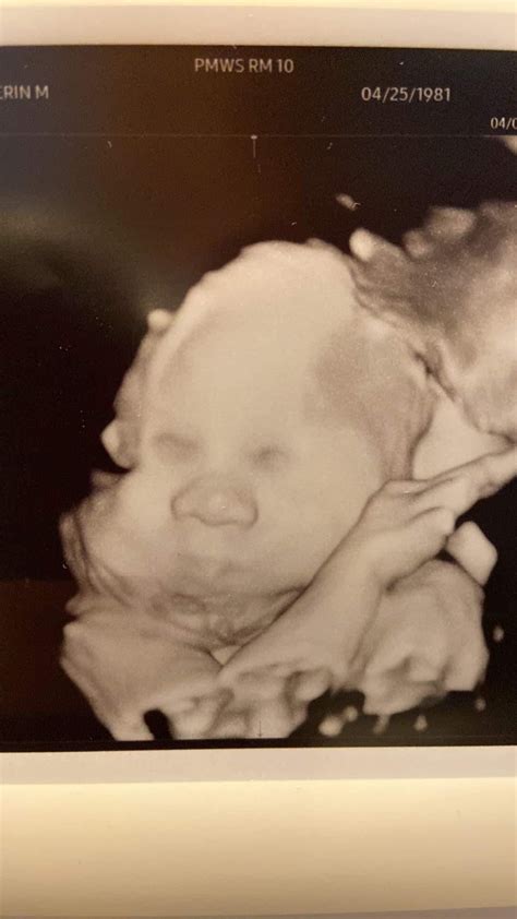 32 week ultrasound - missing eyes? : r/pregnancyproblems