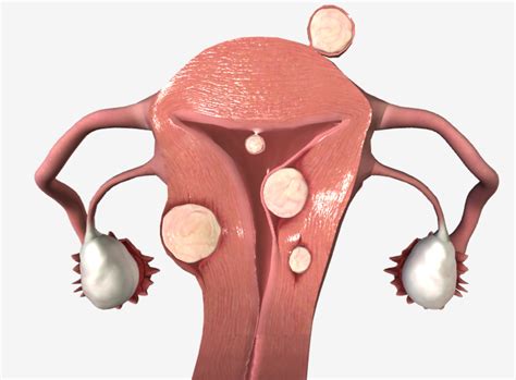 Uterine Fibroid: Video, Anatomy, Definition – YLEAV