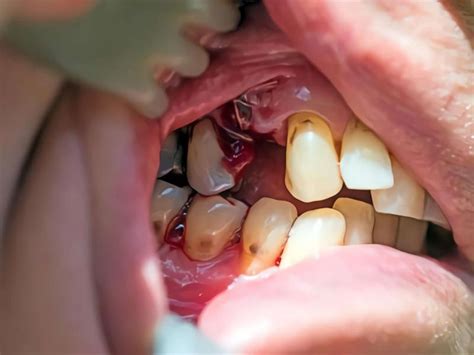 When Does the Blood Clot Go Away After Tooth Extraction? 7 Best Checklists