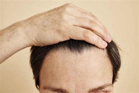7 Ways to Tell Your Hairline is Receding (and Treatments)