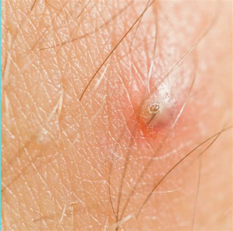 Genital Ingrown Hair Removal at Ebony Dunlop blog