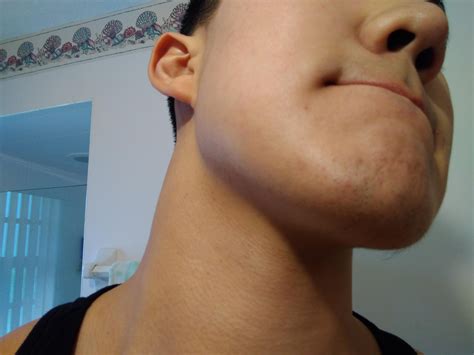 Will minoxidil work if I literally have 0 facial hair other than a few hairs on my chin and a ...