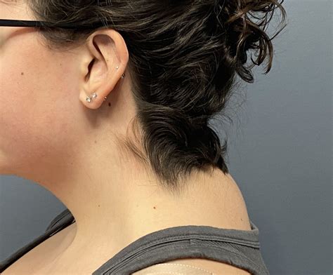 Plastic Surgery Case Study - Webbed Neck Correction with Buffalo Hump ...