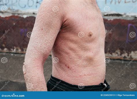 A Man with Psoriasis on His Back and Neck. Scratch with His Hand. Psoriasis Vulgaris Skin ...