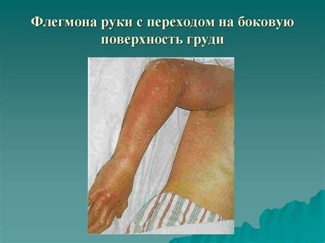 Хирургические инфекции - презентация онлайн