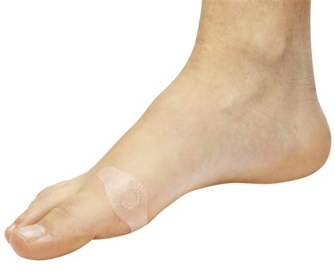 Todo sobre los juanetes en los pies, tipos y tratamientos - España