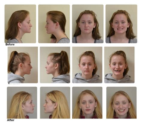 Rapid Palatal Expander Before And After at Madison Calder blog