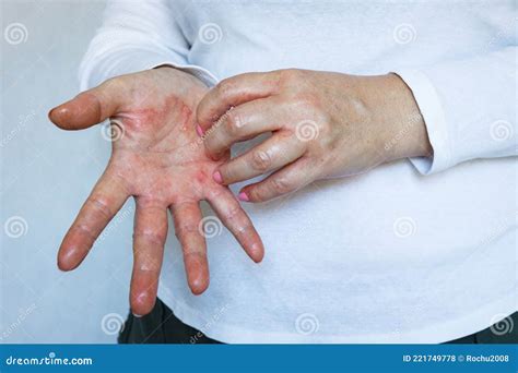 Red Cracked Skin with Leaking Lymph, Woman Scratching Hands with Eczema, Health Concept, Bright ...