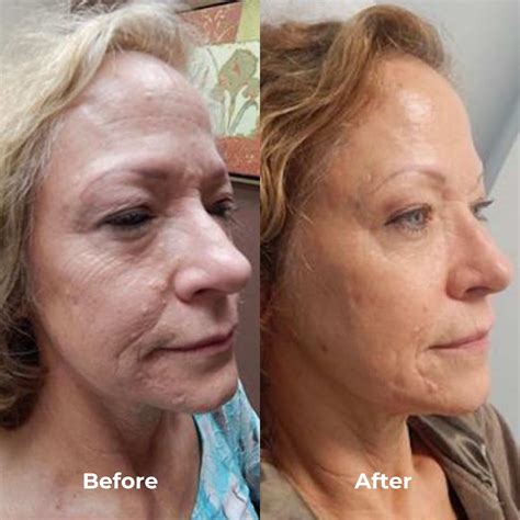 RF Microneedling Before & After Results