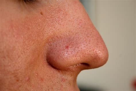 Blackheads On Nose