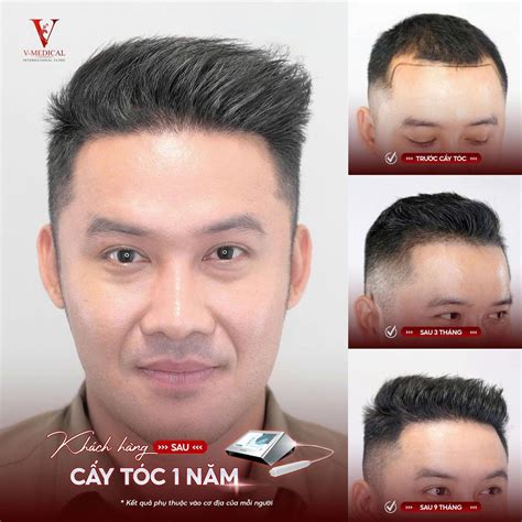 kiểu tóc dành cho người hói đỉnh đầu | Vmedicalclinic.vn