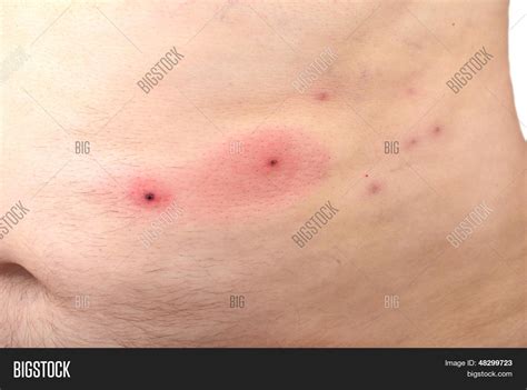 Leech Bites Image & Photo (Free Trial) | Bigstock