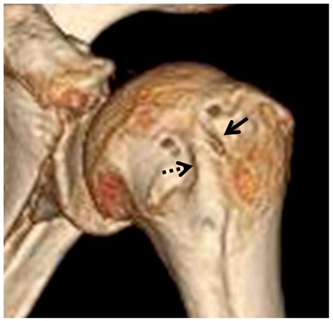 Anatomical Analysis of Bicipital Groove and Its Spur Formation Using 3D-CT: A Retrospective ...