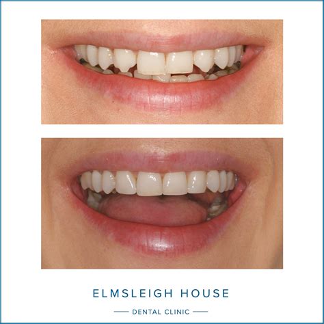 Do You Need Canine Teeth